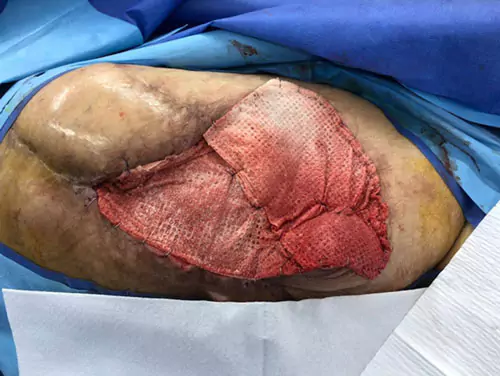 Intra-operative myriad placement