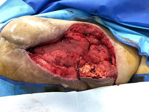 Pre-operative
